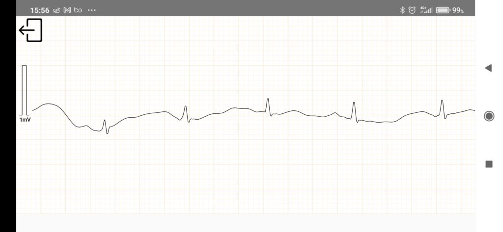 Utilizzo elettrocardiografo ECG portatile Wellue DuoEK S con App ViHealth